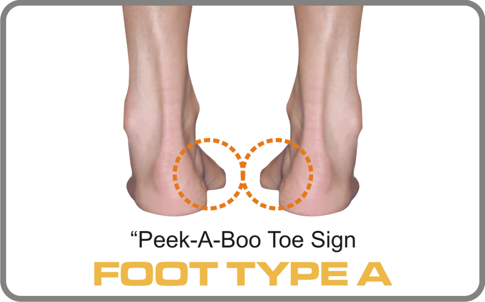 Anterior view of the foot showing the peek-a-boo sign in detail on the